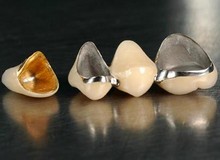 металлокерамические зубные коронки